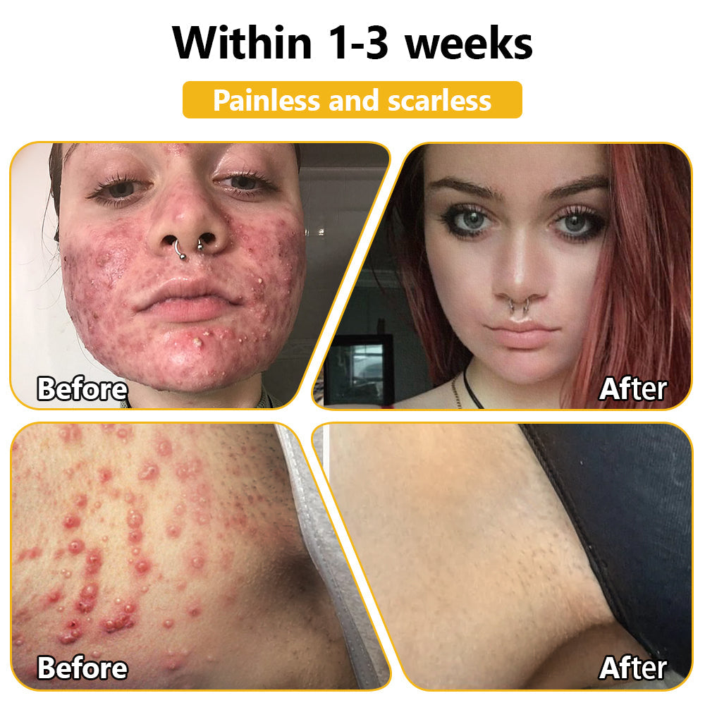 PUROSA® BEE VENOM Skin Restoration Cream – 🌸Targets Sagging Skin, Fine Lines, and Loss of Firmness on Chest, Neck & Body | Lifts & Firms Naturally 🔥 LAST DAY: 80% OFF!