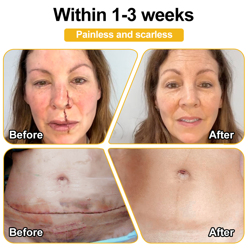 PUROSA® BEE VENOM Skin Restoration Cream – 🌸Targets Sagging Skin, Fine Lines, and Loss of Firmness on Chest, Neck & Body | Lifts & Firms Naturally 🔥 LAST DAY: 80% OFF!