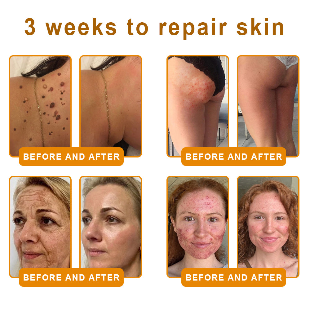 PUROSA® BEE VENOM Skin Restoration Cream – 🌸Targets Sagging Skin, Fine Lines, and Loss of Firmness on Chest, Neck & Body | Lifts & Firms Naturally 🔥 LAST DAY: 80% OFF!