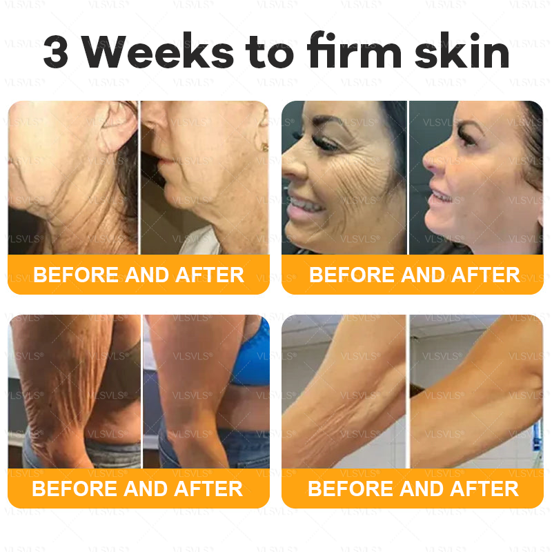 VLSVLS® 𝘽𝙀𝙀 𝙑𝙀𝙉𝙊𝙈 𝑺𝒌𝒊𝒏 𝑹𝒆𝒔𝒕𝒐𝒓𝒂𝒕𝒊𝒐𝒏 𝑪𝒓𝒆𝒂𝒎 –🌸 Anti-aging,Hydrating, Skin Repair, Even Tone, Acne and Dark Spot Treatment, Wart and Mole Removal, Psoriasis Relief