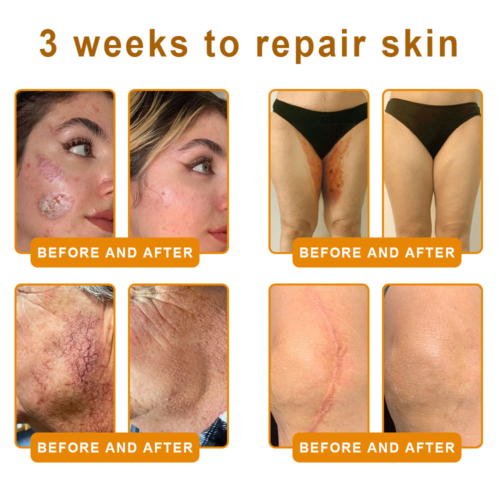 VLSVLS® 𝘽𝙀𝙀 𝙑𝙀𝙉𝙊𝙈 𝑺𝒌𝒊𝒏 𝑹𝒆𝒔𝒕𝒐𝒓𝒂𝒕𝒊𝒐𝒏 𝑪𝒓𝒆𝒂𝒎 –🌸 Anti-aging,Hydrating, Skin Repair, Even Tone, Acne and Dark Spot Treatment, Wart and Mole Removal, Psoriasis Relief