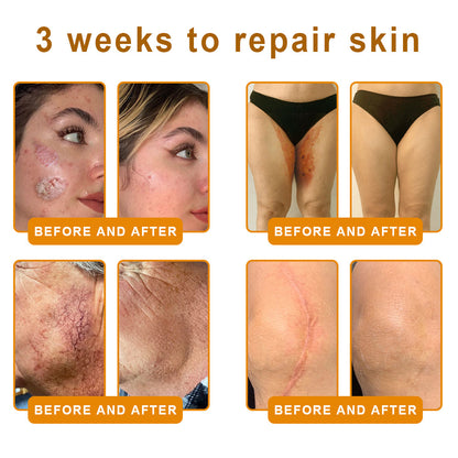 VLSVLS® 𝘽𝙀𝙀 𝙑𝙀𝙉𝙊𝙈 𝑺𝒌𝒊𝒏 𝑹𝒆𝒔𝒕𝒐𝒓𝒂𝒕𝒊𝒐𝒏 𝑪𝒓𝒆𝒂𝒎 –🌸 Anti-aging,Hydrating, Skin Repair, Even Tone, Acne and Dark Spot Treatment, Wart and Mole Removal, Psoriasis Relief