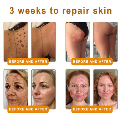 VLSVLS® 𝘽𝙀𝙀 𝙑𝙀𝙉𝙊𝙈 𝑺𝒌𝒊𝒏 𝑹𝒆𝒔𝒕𝒐𝒓𝒂𝒕𝒊𝒐𝒏 𝑪𝒓𝒆𝒂𝒎 –🌸 Anti-aging,Hydrating, Skin Repair, Even Tone, Acne and Dark Spot Treatment, Wart and Mole Removal, Psoriasis Relief